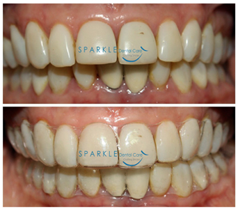 CLEAR ALIGNERS