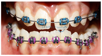 CONVENTIONAL ORTHODONTIC CORRECTION