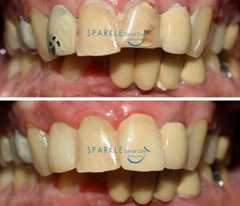 CORRECTION OF OLD CROWNS