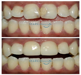 CORRECTION USING PORCELAIN LAMINATE VENEERS