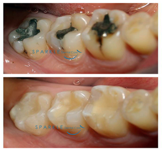 CORRECTION OF SILVER AMALGAM