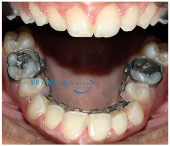 LINGUAL ORTHODONTICS