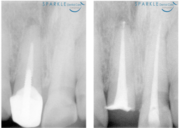 Re-Root Canal Treatment
