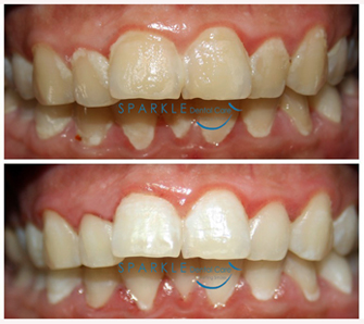 TOOTH WHITENING